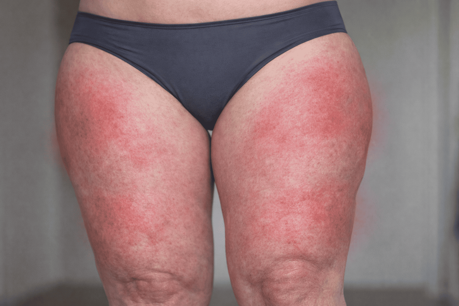 Lipedema: cos’è, sintomi e come gestirlo con alimentazione e attività fisica